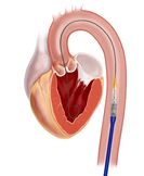 Edwards SAPIEN (TAVI) | Technika a materiál | Odborník - Kardiochirurgie