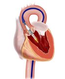 Edwards SAPIEN (TAVI) | Technika a materiál | Odborník - Kardiochirurgie